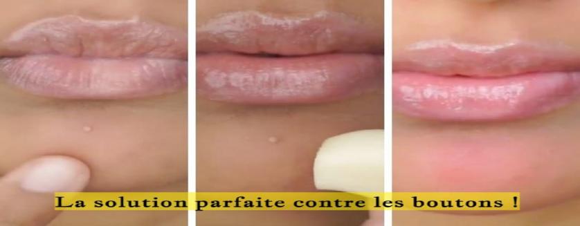 La solution parfaite contre les boutons !