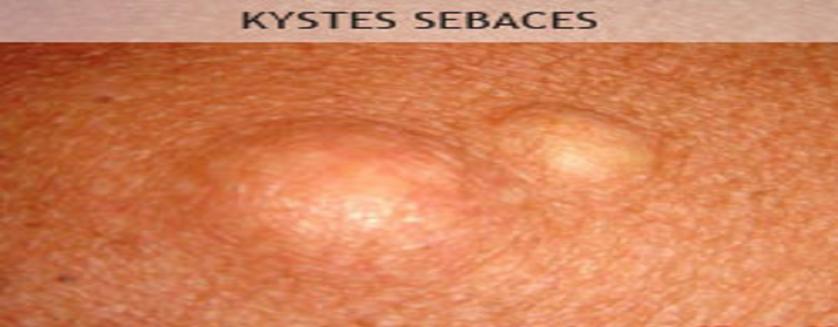 Tout ce que vous devez savoir sur les kystes graisseux: