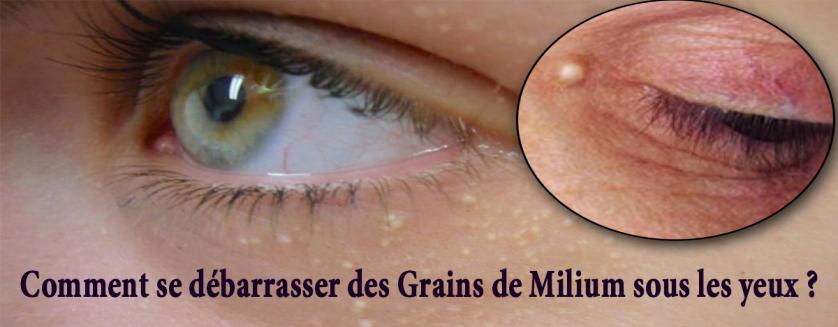 Comment se débarrasser des Grains de Milium sous les yeux ? 