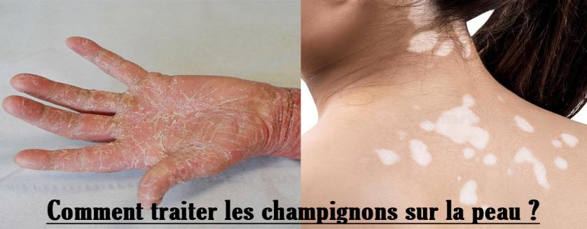 Comment traiter les champignons sur la peau ?