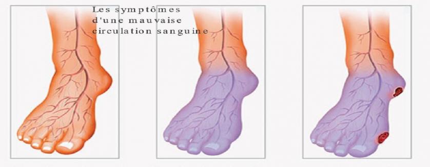 Les symptômes d'une mauvaise circulation sanguine