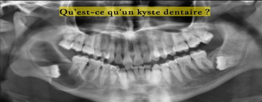 Qu'est-ce qu'un kyste dentaire ?