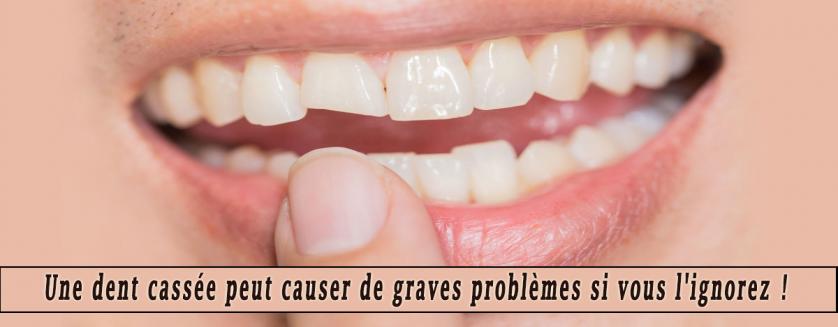 Une dent cassée peut causer de graves problèmes si vous l'ignorez !