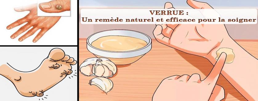 VERRUE : Un remède naturel et efficace pour la soigner